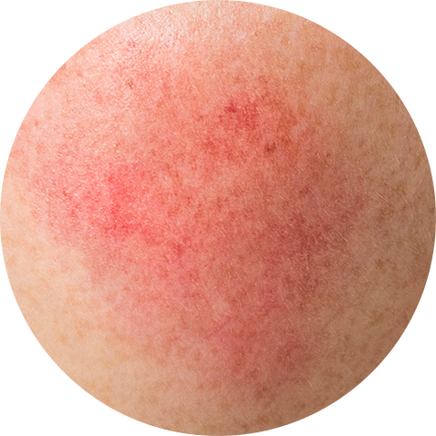 臉部泛紅、血管治療圖片